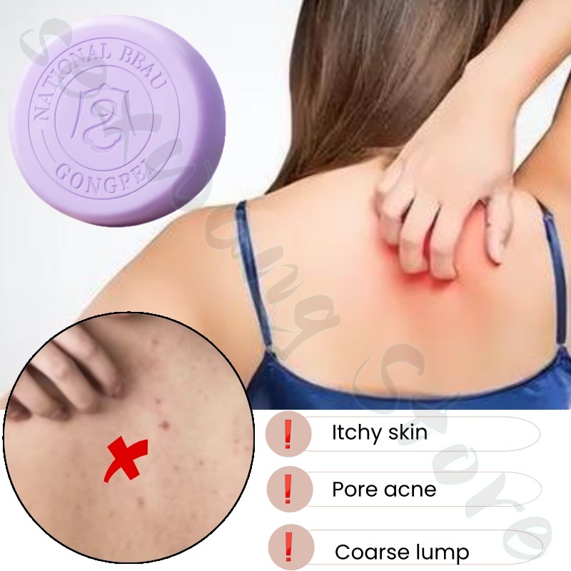 Salicylic acid perilla demodex - Salicylic Acid Blackhead Remover 评论和价格